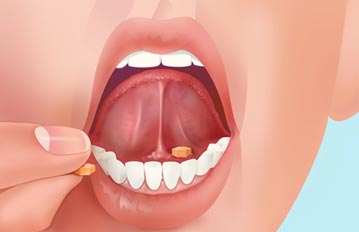 ยาอมใต้ลิ้นและกระพุ้งแก้ม (Sublingual and buccal tablets)